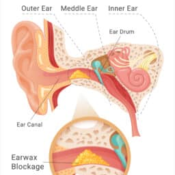 Diagram of earwax blockage