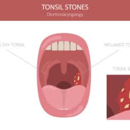 Tonsil stone illustrations