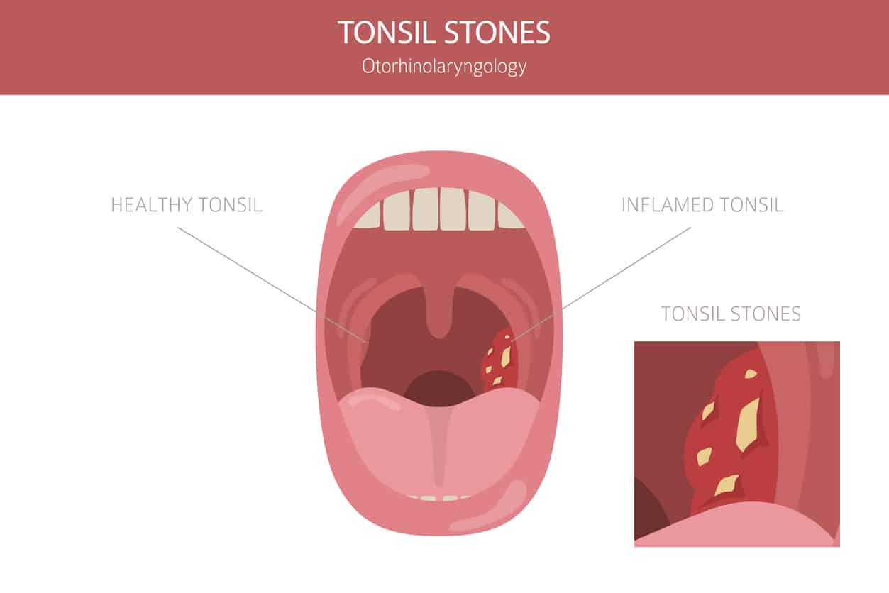 Tonsil stone illustrations
