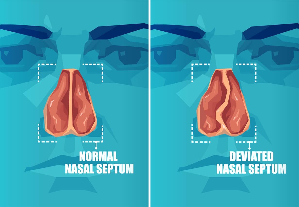 Vector cross section of human face with deviated and normal nasal septum